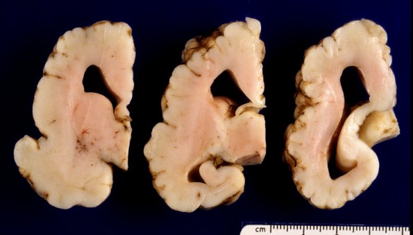 7A3 Agenesis corpus callosum, partial, polymicrogyria (Case 7) A4