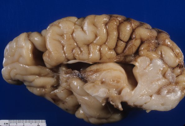 8A1 Agenesis Corpus Callosum, partial with Partial Holoprosencephaly (Case 8) 2