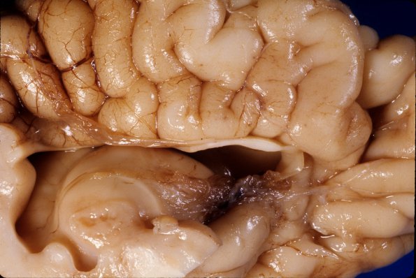 8A2 Agenesis Corpus Callosum, partial with Partial Holoprosencephaly (Case 8) 4