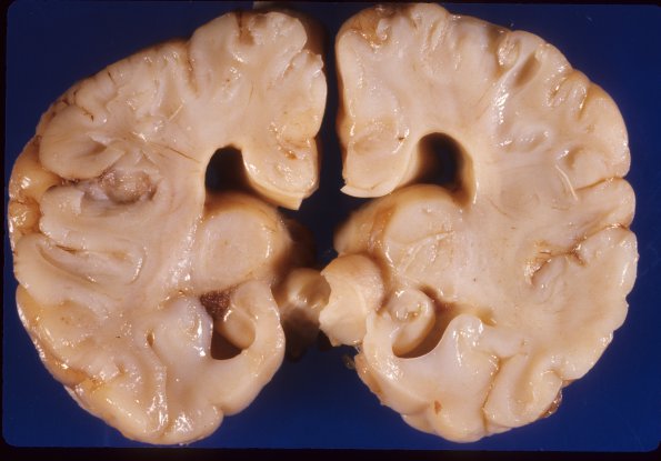 8A3 Agenesis Corpus Callosum, partial with partial Holoprosencephaly (Case 8) 1