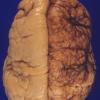 1A1 Pachygyria (Case 1) 1a