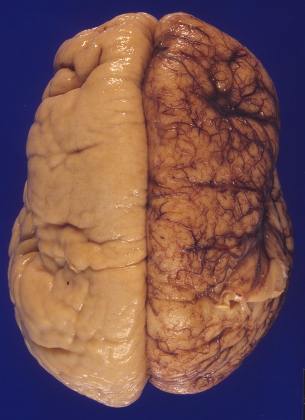 1A1 Pachygyria (Case 1) 1a