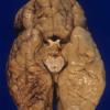 1A2 Pachygyria (Case 1) A1 (2)