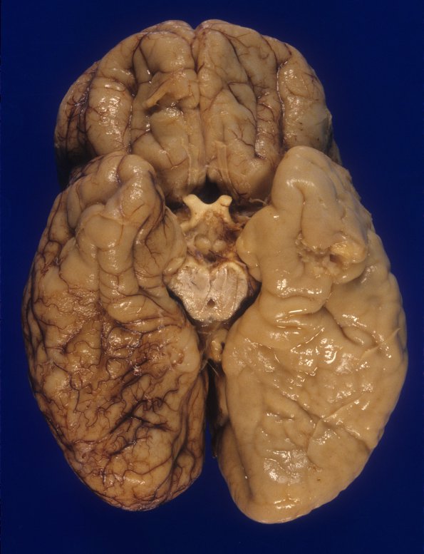 1A2 Pachygyria (Case 1) A1 (2)