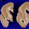 1A5 Pachygyria (Case 1) 8