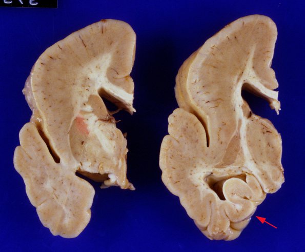 1A5 Pachygyria (Case 1) 8