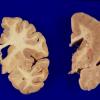 1A7 Pachygyria (Case 1) 1