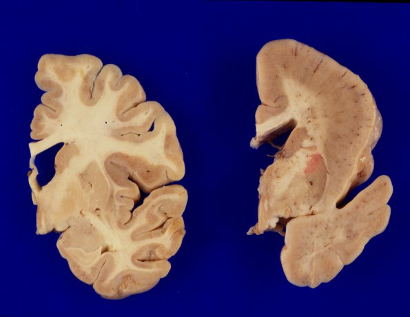 1A7 Pachygyria (Case 1) 1