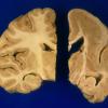 1A8 Pachygyria (Case 1) A6 (2)