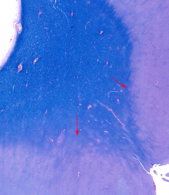 1B2 Pachygyria (Case 1) LFB-PAS 0