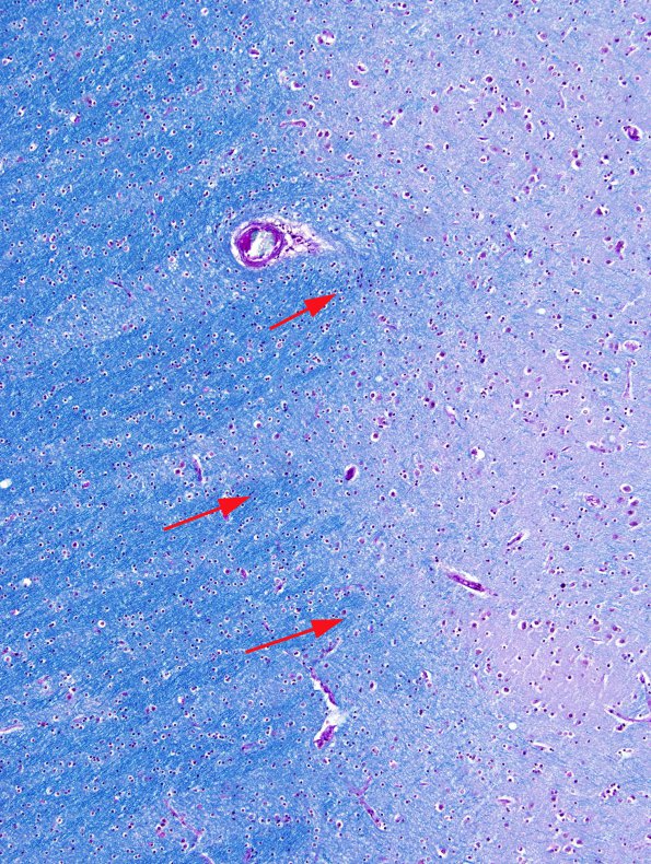 1B3 Pachygyria (Case 1) LFB-PAS 6