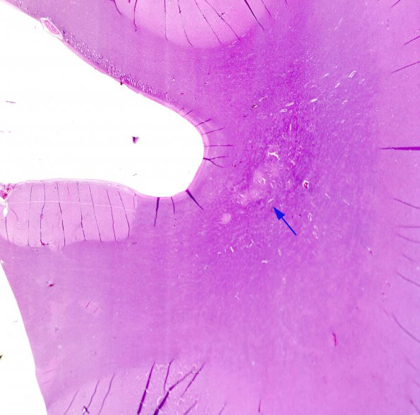 1C1 Pachygyria (Case 1) H&E 2