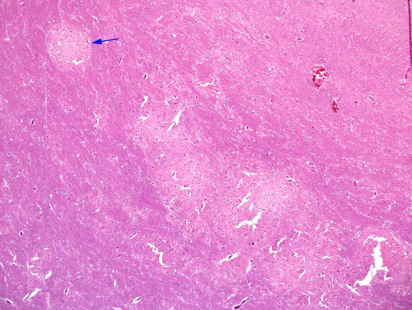 1C2 Pachygyria (Case 1) H&E 15