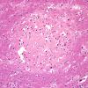 1C3 Pachygyria (Case 1) H&E 13