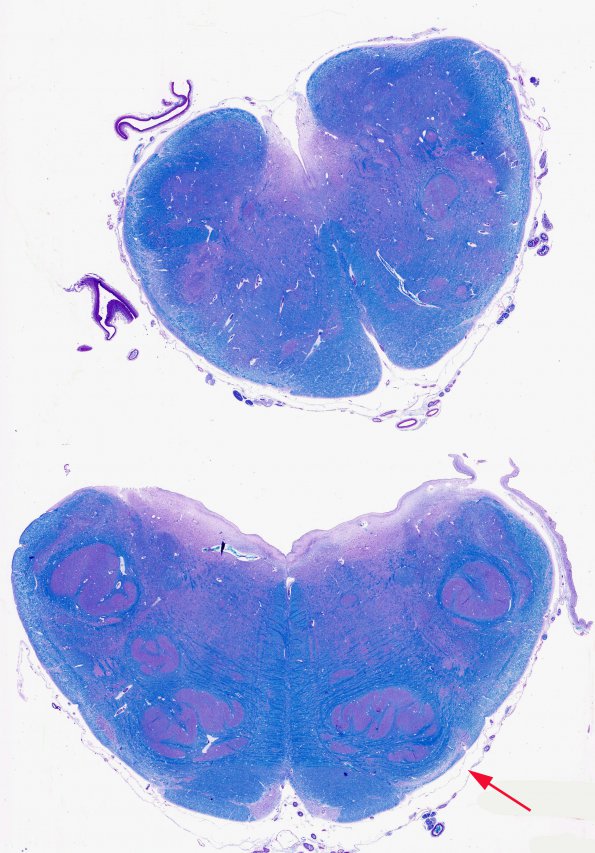 1D1 Pachygyria (Case 1) Medulla LFB-PAS 3