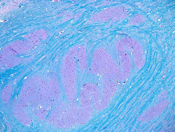 1D2 Pachygyria (Case 1) Medulla LFB-PAS 3