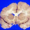 3A1 Pachygyria (Case 3) 9