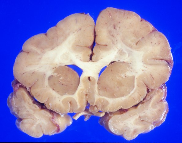 3A1 Pachygyria (Case 3) 9