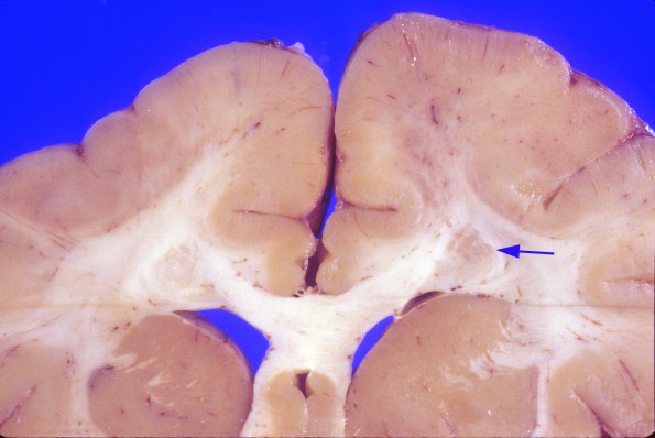 3A2 Pachygyria (Case 3) 3