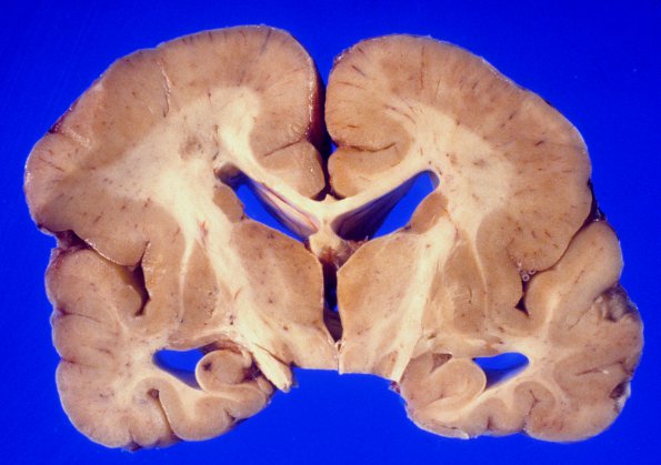 3A3 Pachygyria (Case 3) 8