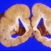 3A4 Pachygyria (Case 3) 10