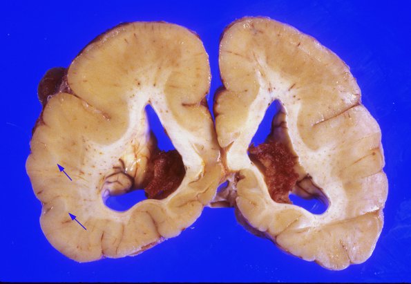 3A4 Pachygyria (Case 3) 10