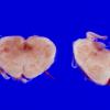 3A5 Pachygyria (Case 3) 4