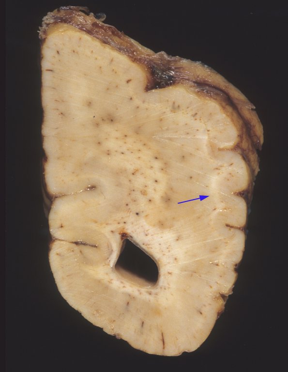 4 Pachygyria (Case 4) a