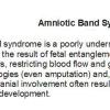 0 Amniotic band syndrome