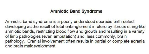 0 Amniotic band syndrome