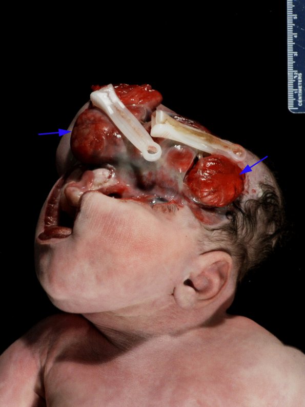 1A1 Amniotic band syndrome (Case 1) 2