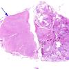 1B1 Amniotic band syndrome (Case 1) H&E whole mount 2