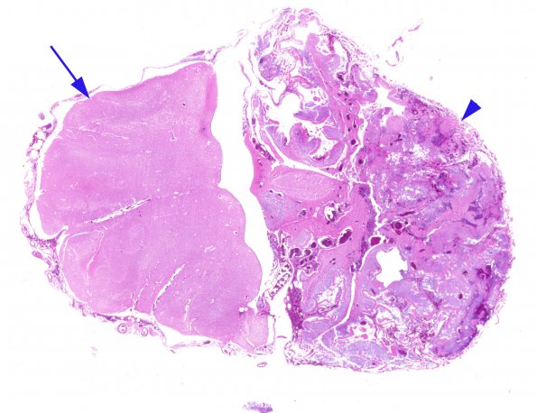 1B1 Amniotic band syndrome (Case 1) H&E whole mount 2