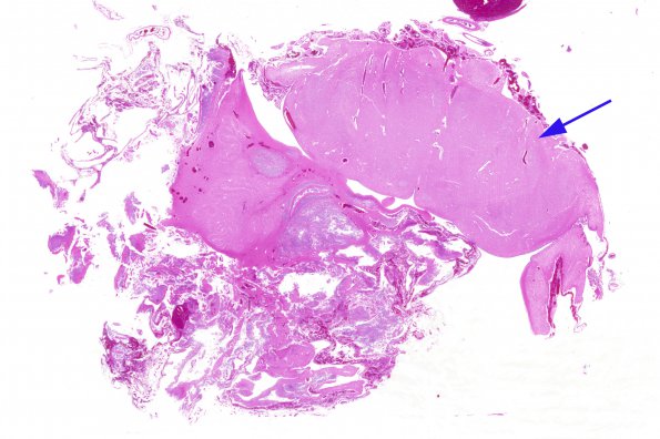 1B2 Amniotic band syndrome (Case 1) H&E whole mount