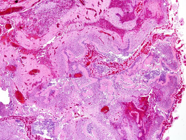 1B3 Amniotic band syndrome (Case 1) H&E 3