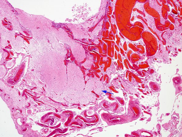 1B4 Amniotic band syndrome (Case 1) H&E 7