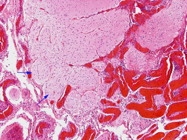 1B5 Amniotic band syndrome (Case 1) H&E 6