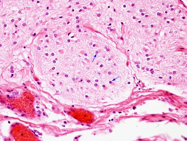 1B6 Amniotic band syndrome (Case 1) H&E 4