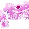 1C3 Amniotic band syndrome (Case 1) Placenta H&E whole mount