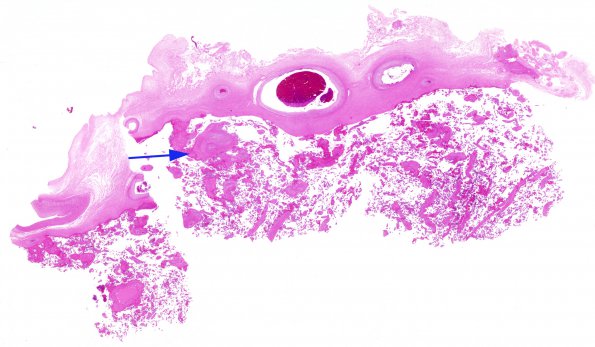 1C3 Amniotic band syndrome (Case 1) Placenta H&E whole mount