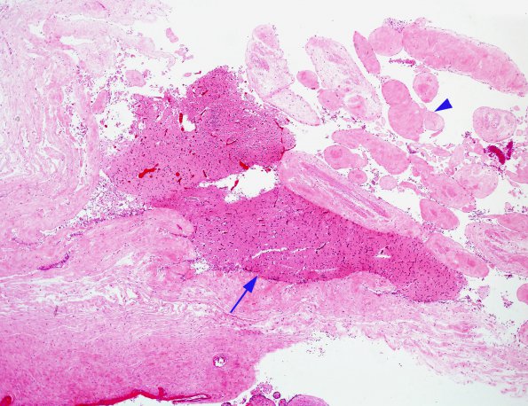 1C4 Amniotic band syndrome (Case 1) Placenta H&E 2