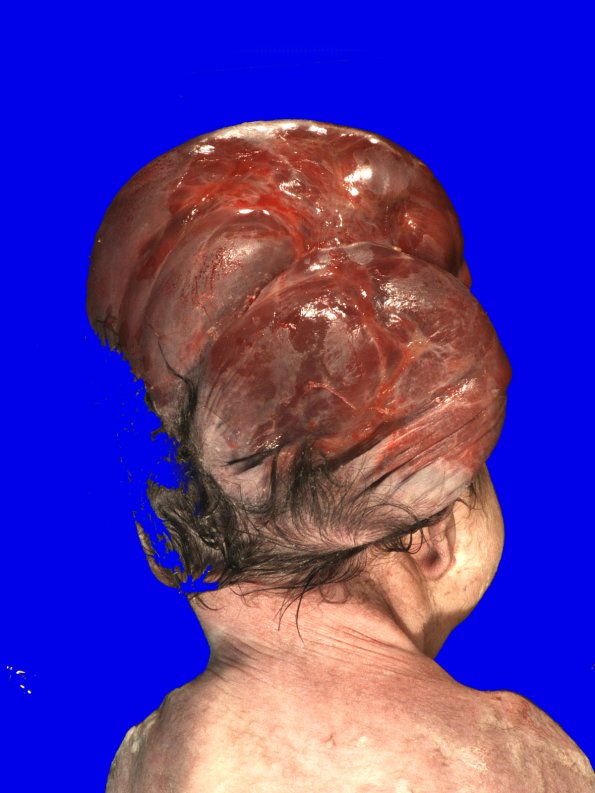 2A3 Amniotic Band Syndrome (Case 2) 6 A