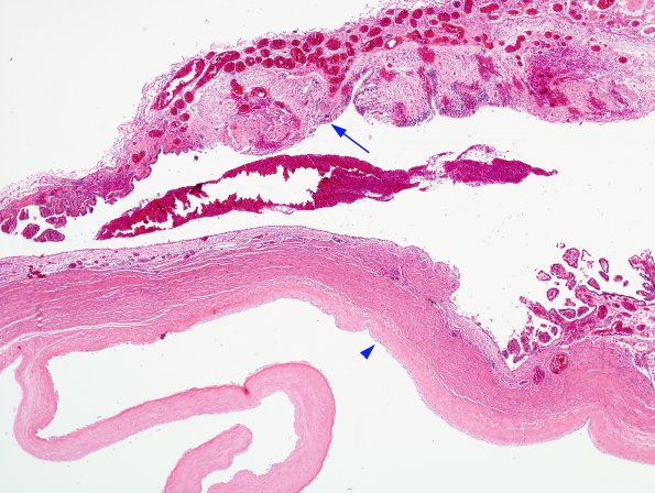 2B1 Amniotic Band Syndrome (Case 2) H&E 2