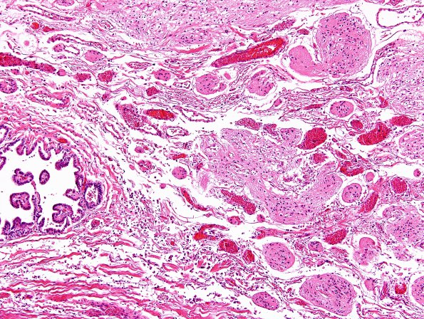 2B2 Amniotic Band Syndrome (Case 2) H&E 5