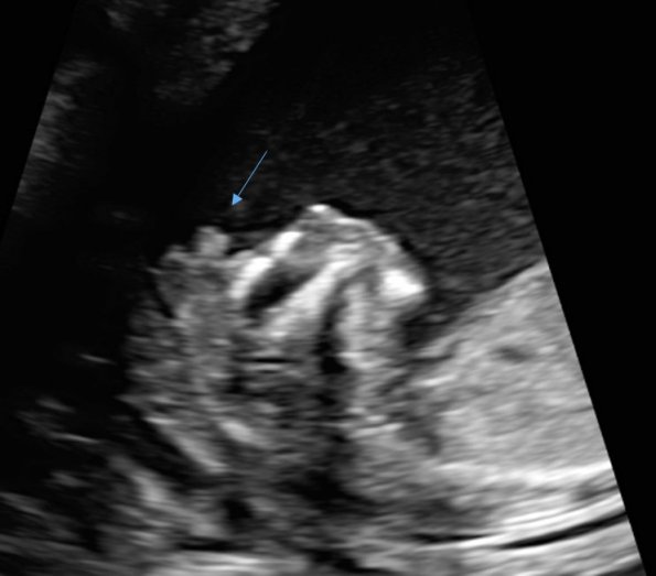 10A1 Exencephaly-Anencephaly (Brain without skull at arrow, Case 6) 1