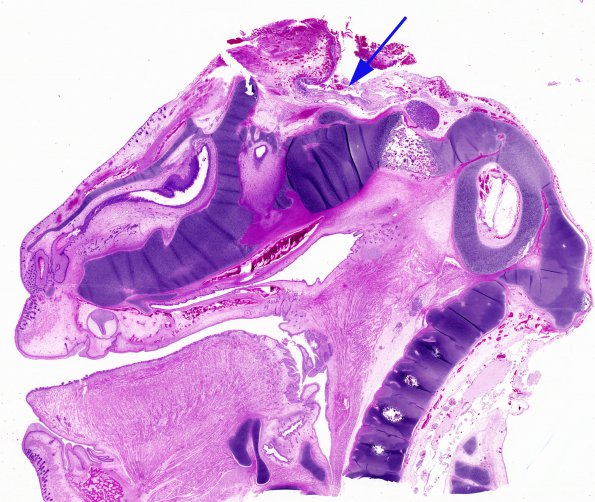 10B1 Anencephaly (Case 10)