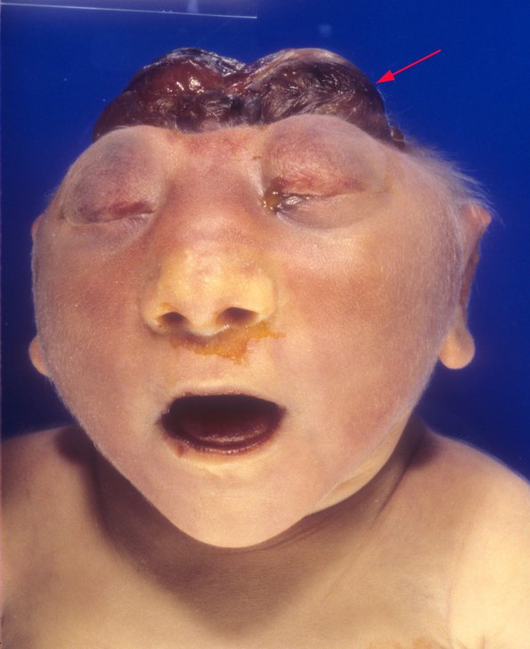 1A1 Anencephaly (Case 1) 2