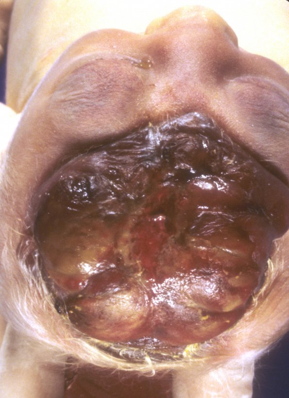 1A2 Anencephaly (Case 1) 7