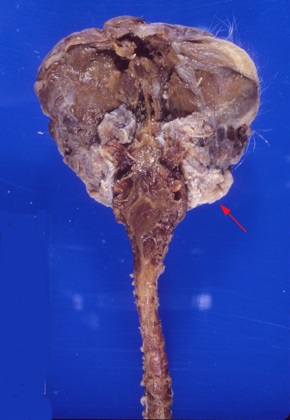 1A4 Anencephaly (Case 1) 4a