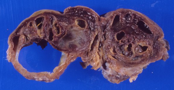 1A5 Anencephaly (Case 1) 3